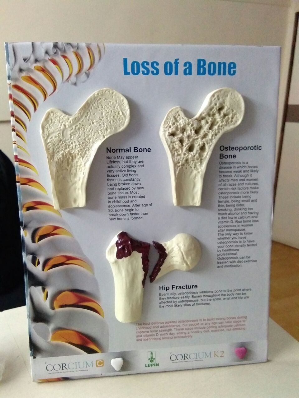 Loss Of Bone Model